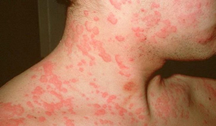 Аллергия на коже у взрослых, симптомы, диагностика, лечение