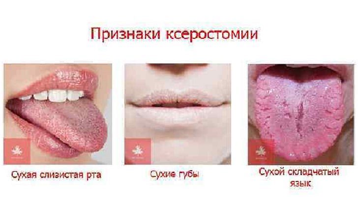 Болезни полости рта