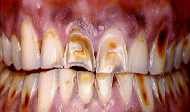 Болезни зубов некариозного происхождения фото с описанием у взрослых
