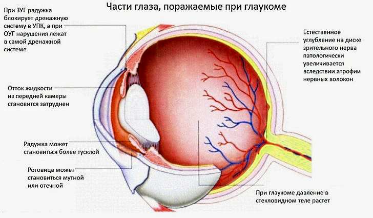 Что такое глаукома. Как лечить глаукому без операции