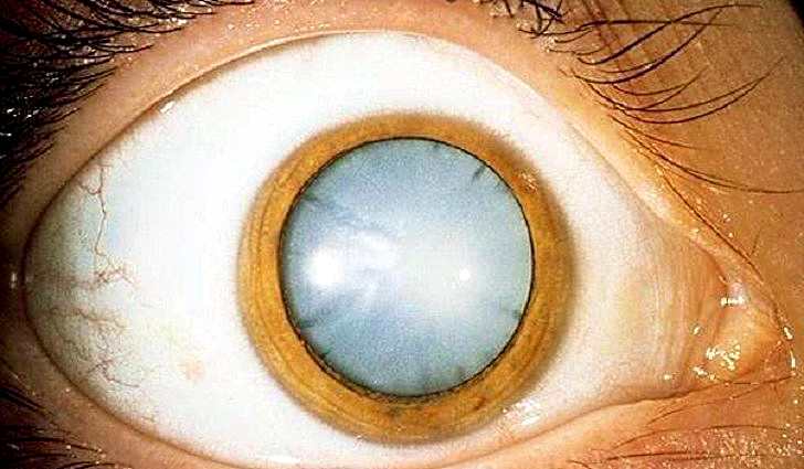 Что такое хрусталик глаза?