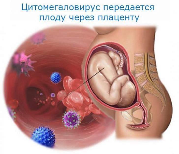 Цитомегаловирусная инфекция у беременной