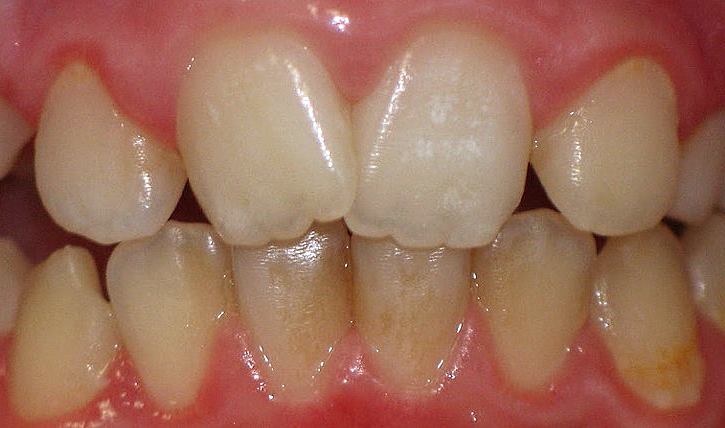 Гиперплазия зубов