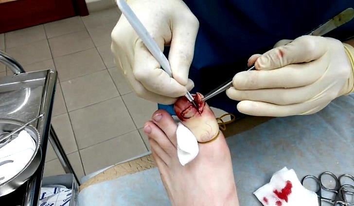 Когда понадобится операция по удалению вросшего ногтя