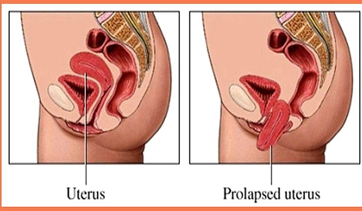 Опущение органов малого таза у женщин