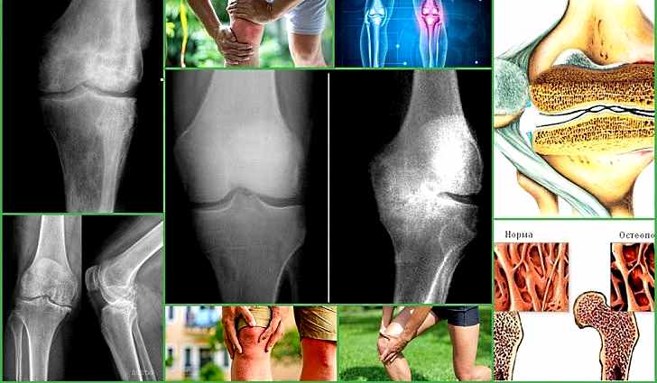 Остеопороз суставов: причины возникновения, симптомы и лечение, препараты