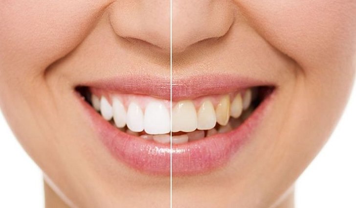 Отбеливание зубов и удаление зубного камня