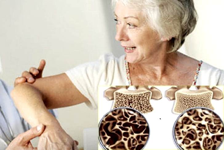 Что такое остеопороз у женщин после 40 лет фото