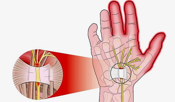 Синдром карпального канала кисти руки, лечение диагностика причины