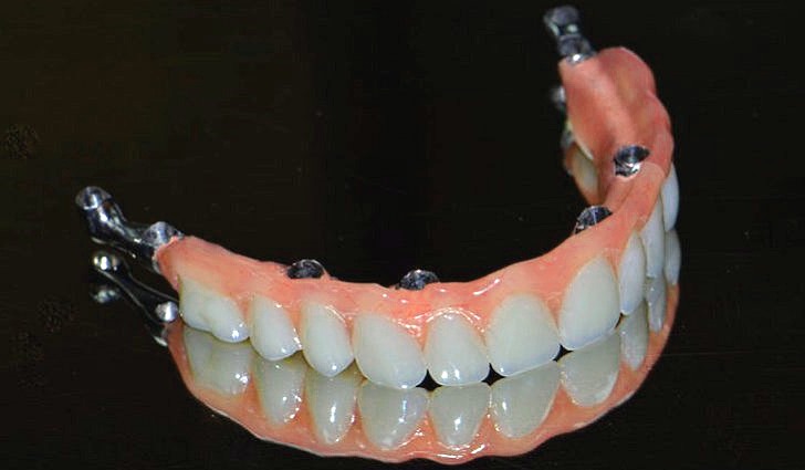 Зубная имплантация или зубное протезирование