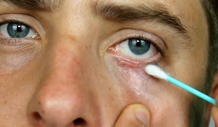 Очень большое количество людей страдает сегодня от глазного клеща-демодекса