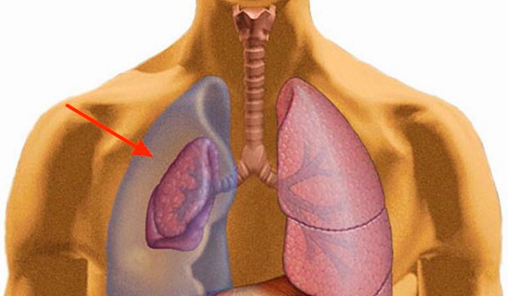 Гемоторакс возникает при травме грудной клетки