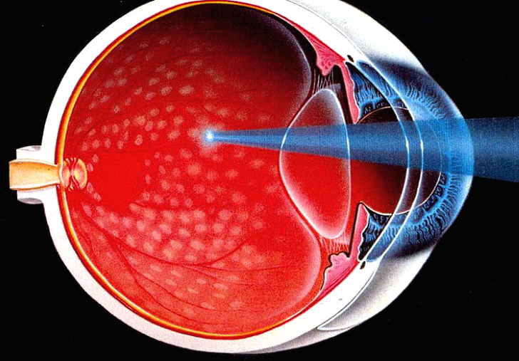Что это такое диабетическая ретинопатия, симптомы, лечение