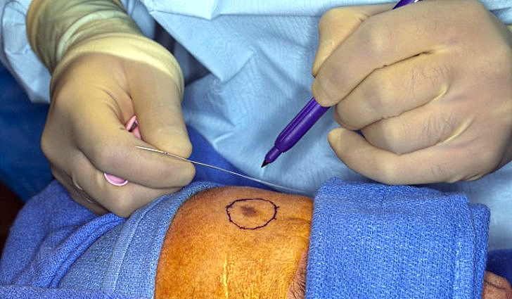 Оперативное удаление меланомы на коже человека