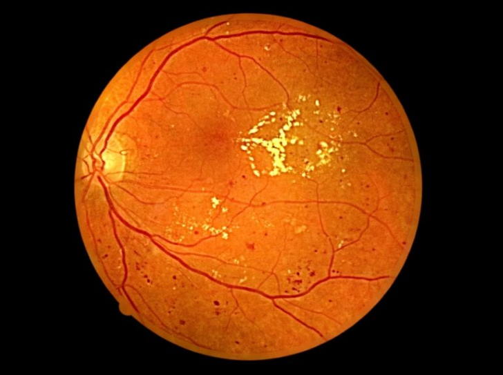 Состояние сетчатки глаза при ретинопатии