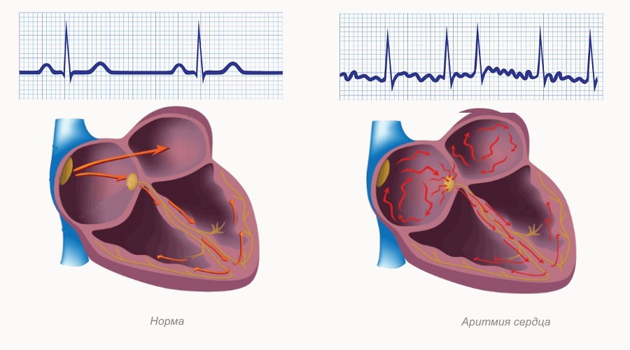 Схема аритмии сердца