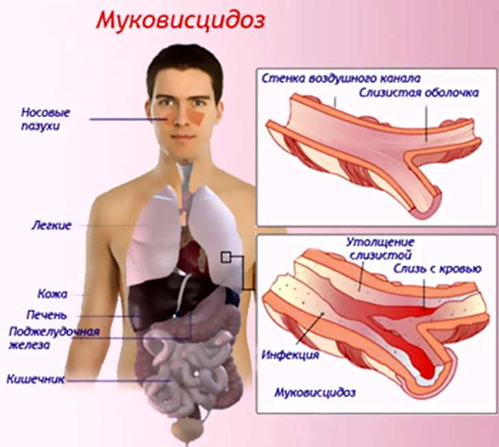 Симптомы муковисцидоза