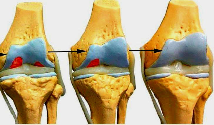 Сустав 1а. Деформирующий гонартроз коленного сустава. Гонартроз- деформирующий артроз коленного сустава. Деформирующий остеоартроз 1 степени коленного. Остеоартроз коленного сустава 1 степени.