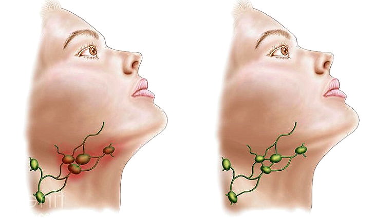 Воспалениеи лимфоузлов в горле причины и лечение