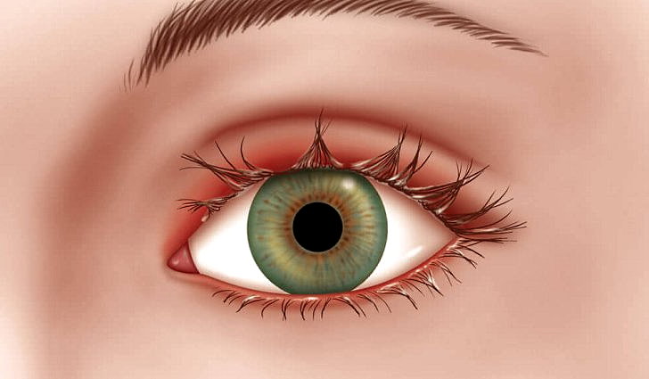 Как выглядит заболевание глаз блефарит